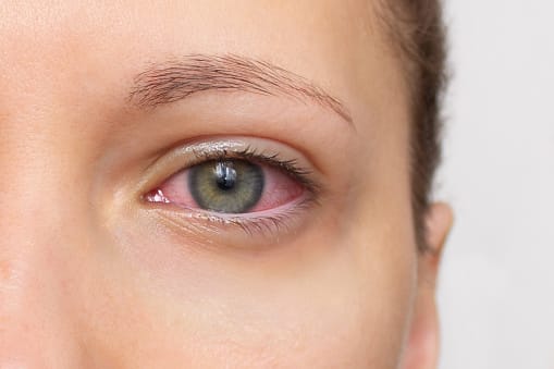 Pink Eye vs Allergies: Key Differences To Look For